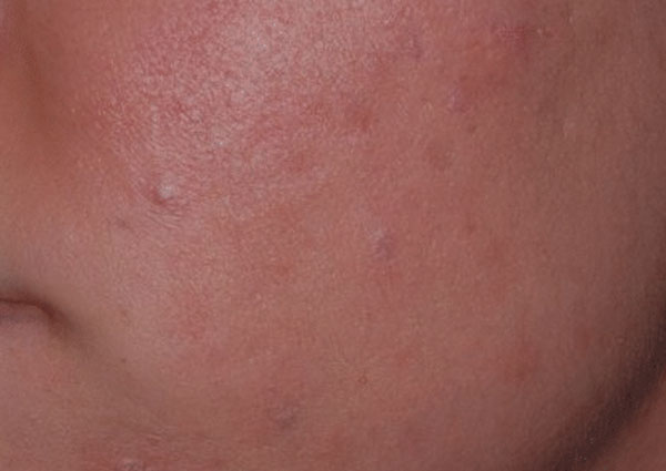 Pre Cancerous Cells And Acne Bacteria Arlington Skin Doctor